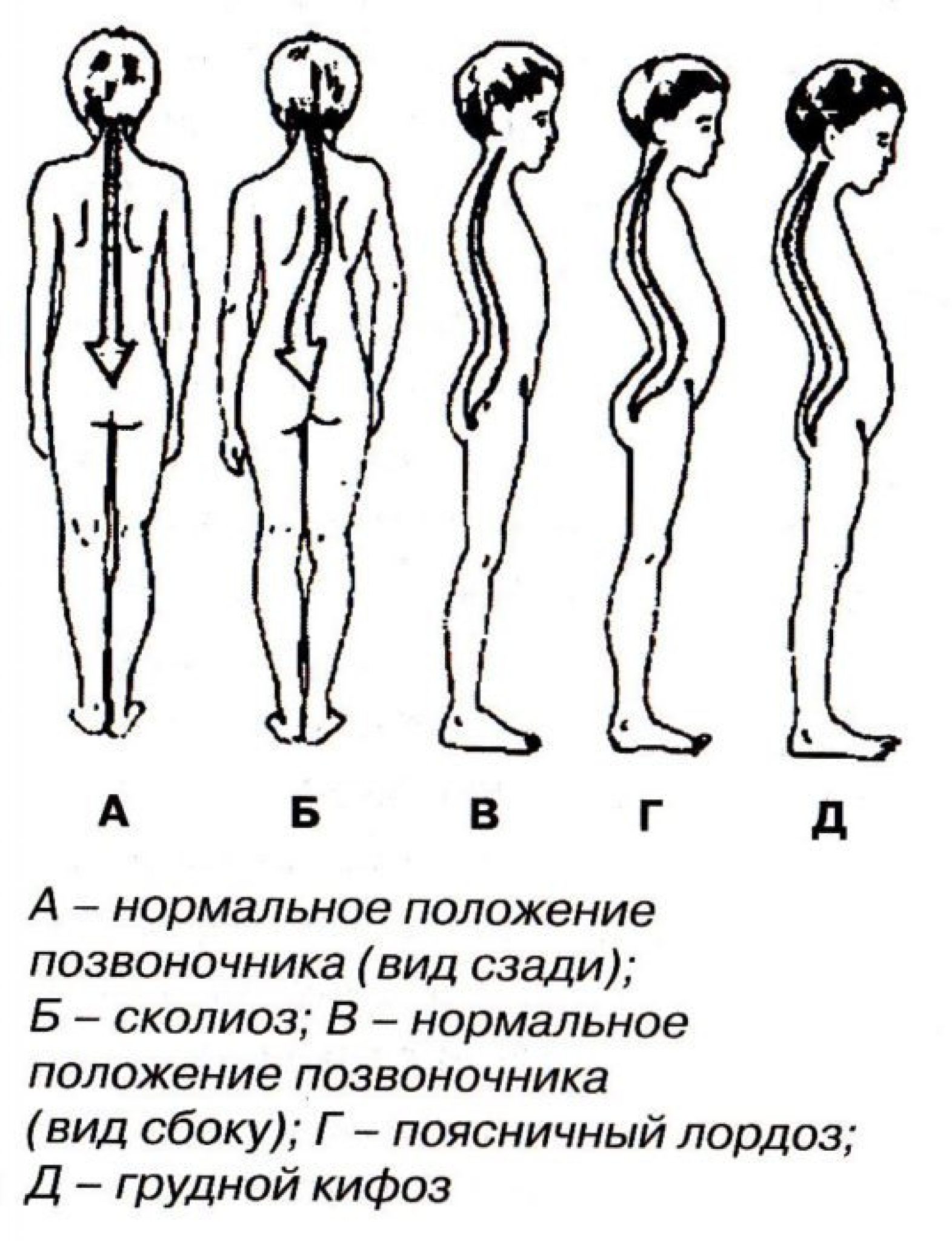 Положение тела на спине. Искривление позвоночника лордоз кифоз сколиоз. Типы нарушения осанки кифоз лордоз. Кифоз 2 степени сколиоз лордоз.